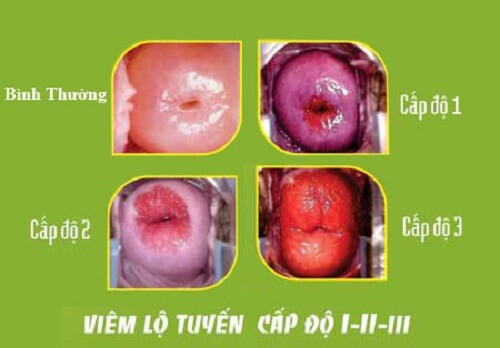 Viêm lộ tuyến cổ tử cung độ 2 